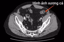 Người đàn ông bị xương cá dài 4 cm đâm thủng ruột non nguy hiểm