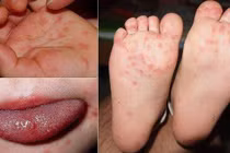 Hà Nội ghi nhận ca mắc bệnh tay chân miệng tăng mạnh, tiềm ẩn biến chứng nặng