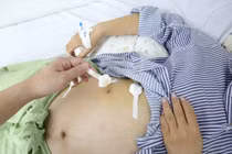 Phẫu thuật nội soi cứu thai phụ 32 tuần bị viêm ruột thừa nguy hiểm