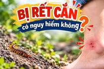 Cảnh báo rết cắn tăng cao tại Quảng Ninh, bác sĩ bày cách sơ cứu hiệu quả