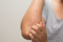 Mùa mưa làm tăng nguy cơ nhiễm ký sinh trùng từ chó, mèo