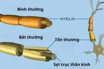  Người đàn ông ở Đắk Lắk mắc hội chứng hiếm Guillain-Barré