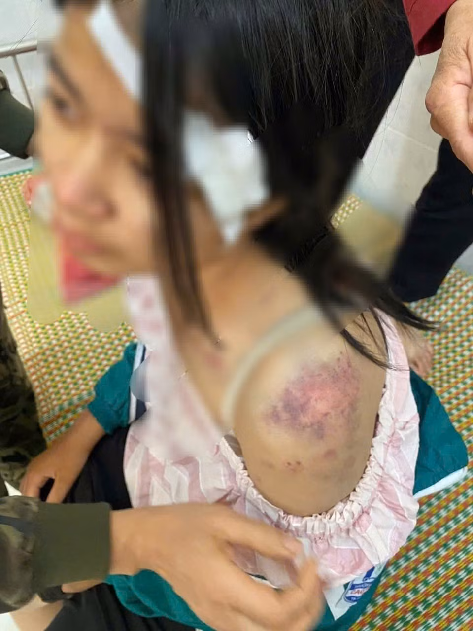 Cơ thể cháu P.A có nhiều thương tích