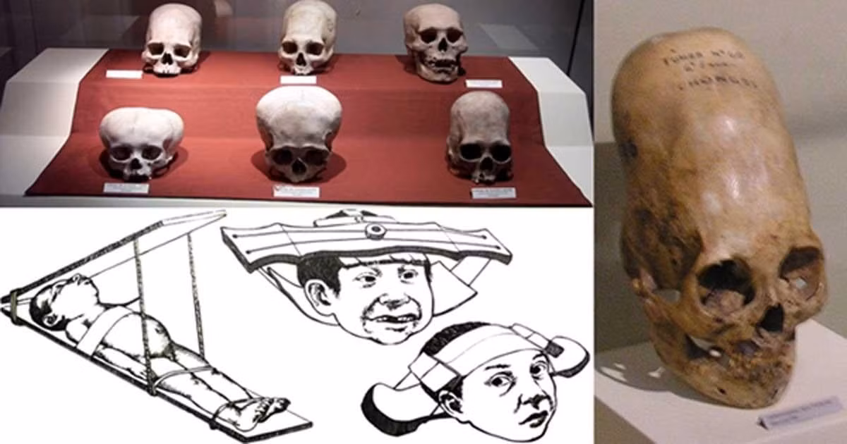 Hầu hết các học giả về việc tạo hình đầu thời cổ đại đều cho rằng tập tục này ít hoặc không có hậu quả tiêu cực nào đối với sức khỏe. Việc thực hành tập tục này có liên quan đến bản sắc xã hội hoặc sở thích nuôi dạy con cái. Ảnh: ancient-origins.