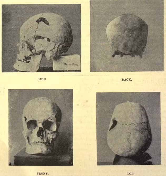 Từ đây, nhóm nghiên cứu cho rằng, pharaoh Sanakht có thể đã mắc bệnh khổng lồ và đây là trường hợp lâu đời nhất mắc căn bệnh này được ghi nhận từ trước đến nay. Ảnh: Royal Anthropological Institute of Great Britain and Ireland.