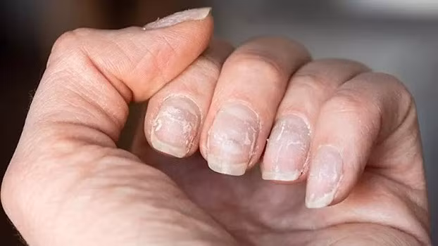 Thậm chí, có người còn gặp “kiếp nạn” gãy móng ngay sau Tết, nhưng vẫn tự an ủi nhau bằng câu nói quen thuộc: “May mà ăn Tết xong mới gãy”. Dù vậy, đa phần đều thừa nhận rằng sau kỳ nghỉ dài, móng tay yếu đi trông thấy, cần thời gian chăm sóc kỹ lưỡng hơn.