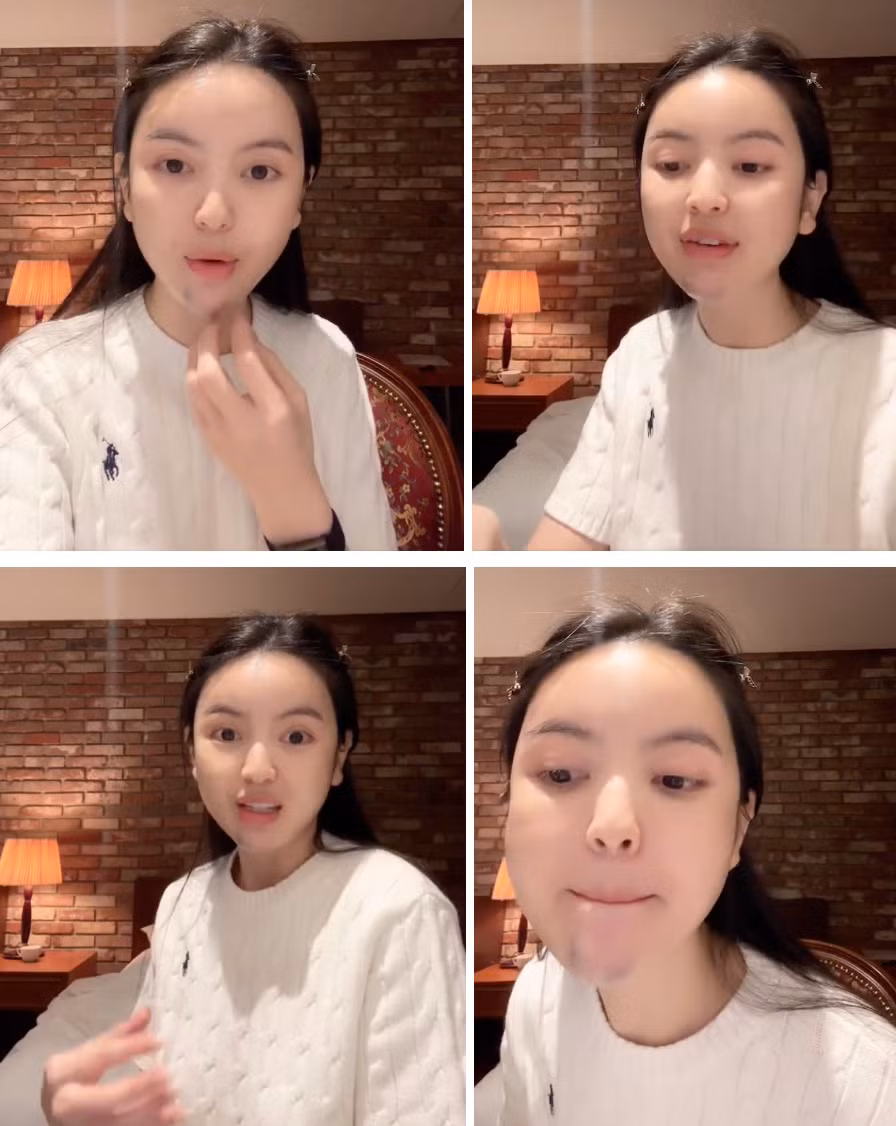 Cũng từ bức ảnh trên, netizen nhanh chóng "soi" ra phần cằm của cô có màu sắc bất thường, tím tái và có phần sưng nhẹ.