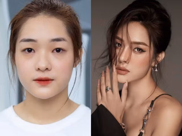 Á hậu 3 Miss Grand Vietnam Lê Thị Hồng Hạnh (sinh năm 2000, Thái Bình cũ) cũng là một trường hợp phẫu thuật thành công.