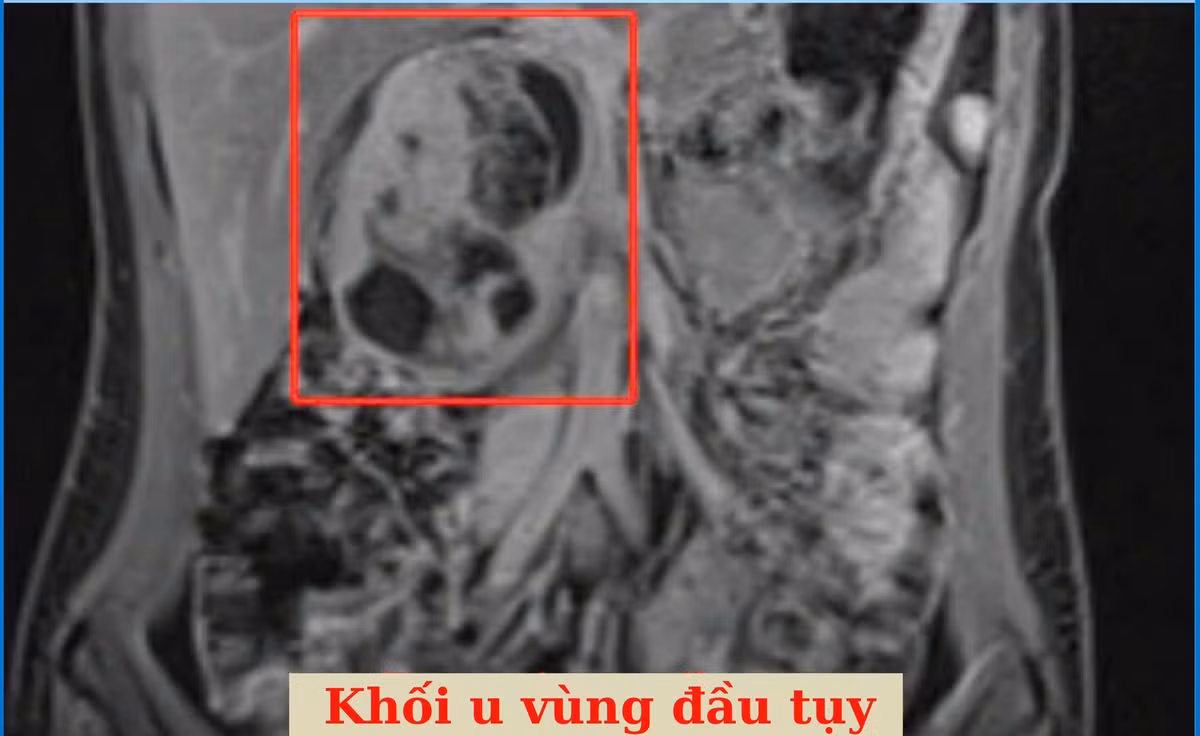 u-dau-tuy-2.jpg
