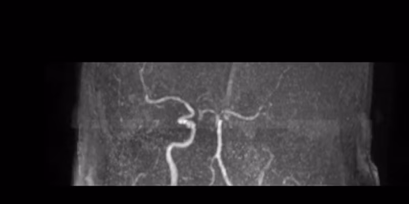 phim-mri-truoc-can-thiep.png
