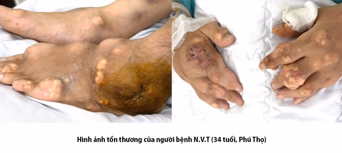 gout-1.jpg
