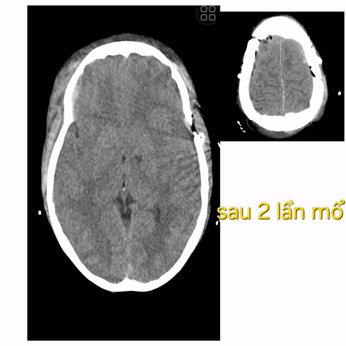 2-lan-mo-nao-3.jpg