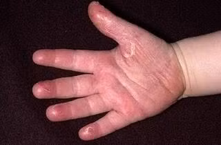 benh-tre-3.jpg