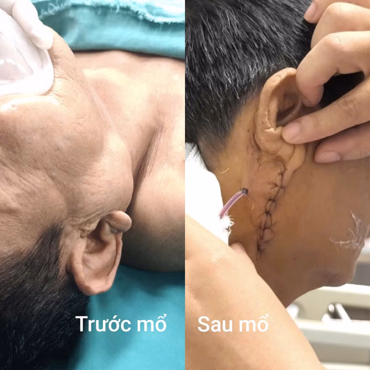 u-tuyen-nuoc-bot.jpg