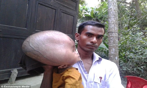 Xót xa em bé đầu nặng 9kg vì não úng thủy