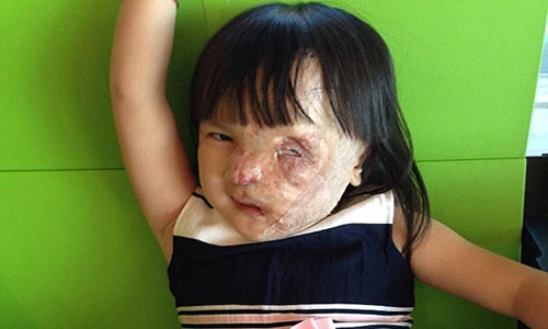 May mắn bất ngờ của bé 5 tuổi bị u che nửa mặt