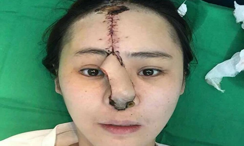 Cô gái xinh đẹp bị mất hẳn mũi vì ham làm đẹp