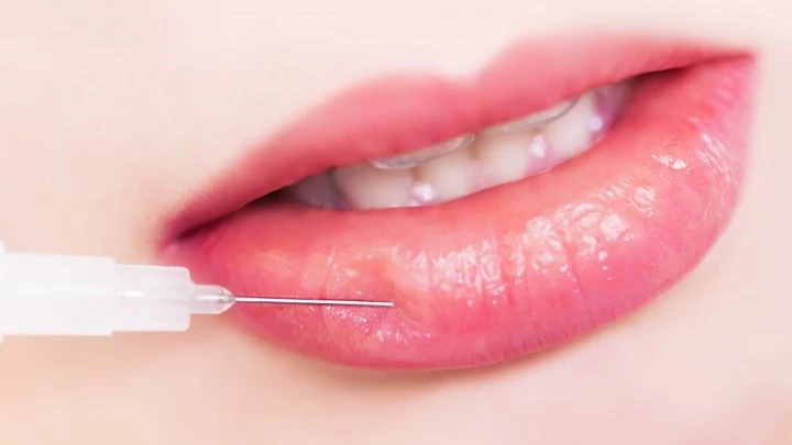 Sự thật tiêm filler môi làm đẹp ít ai biết 