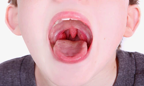 Cách điều trị viêm amiđan tại nhà không cần phẫu thuật