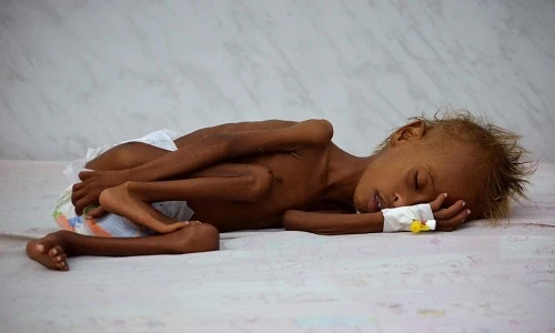 Loạt hình đầy ám ảnh về nạn đói ở Yemen