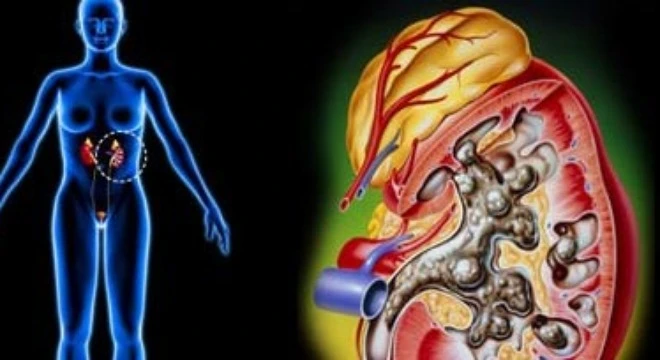 Những thực phẩm gây sỏi thận bạn không nên ăn nhiều