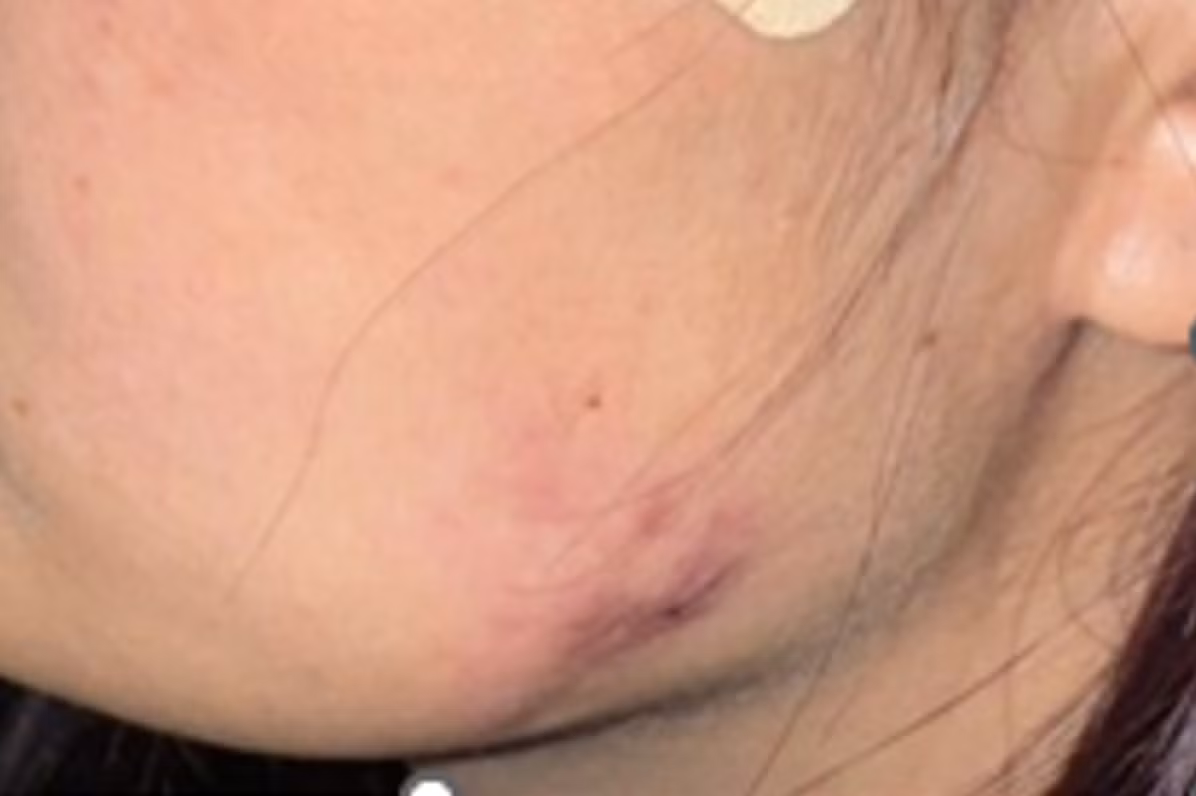 tiem-botox-bien-chung.png