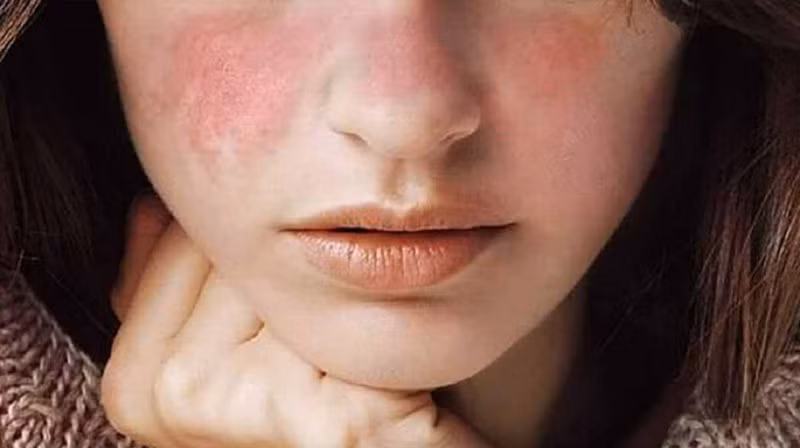Tẩy tế bào chết giúp da sáng khỏe, song lạm dụng các loại axit như glycolic, salicylic dễ làm da kích ứng, viêm và tăng sắc tố. Nên tẩy nhẹ nhàng, có tần suất hợp lý và dưỡng ẩm đầy đủ. Ảnh minh họa