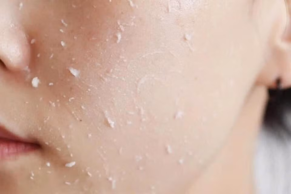 Khi hàng rào da suy yếu, làn da dễ rơi vào tình trạng khô ráp, bong vảy, nhạy cảm và mất cân bằng. Thay vì làm sạch quá mức, bạn nên ưu tiên sữa rửa mặt dịu nhẹ, độ pH phù hợp. Với làn da ít tiết dầu, có thể bỏ qua bước rửa mặt vào buổi sáng. Ảnh minh họa