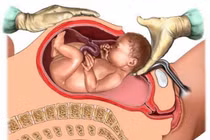 Có nên chủ động sinh mổ sớm?