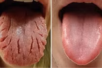 Các dấu hiệu cảnh báo bệnh trên lưỡi