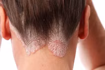Nhận diện bệnh về da dễ nhầm với bệnh truyền nhiễm