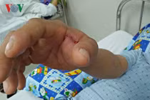 Báo động bệnh nhân bị rắn độc cắn tăng đột biến