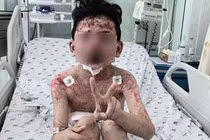 Bé trai mắc bệnh lạ nguy hiểm sau 2 ngày ăn cua