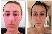 Mỹ nữ bị biến dạng toàn thân vì dùng kem trị eczema