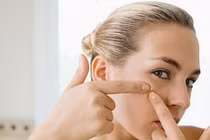 Truy nguyên nhân gây mụn trứng cá ở tuổi trưởng thành