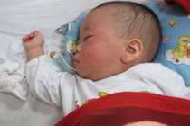 Dịch sởi bùng phát: Bộ Y tế ra công điện khẩn