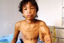 Vì đâu cậu bé Hào Anh sa ngã?