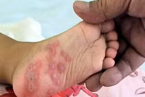 Cảnh báo bệnh tay chân miệng bùng phát mùa khai trường
