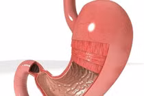 Phân biệt ung thư dạ dày với viêm loét thông thường