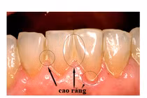Cao răng tự rụng ra, hôi miệng cũng hết hẳn với nguyên liệu này