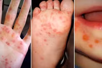 Hà Nội: Ca mắc tay chân miệng tăng nhanh