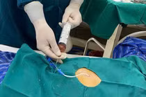 Cứu sống cụ ông bị tràn dịch màng ngoài tim do lao