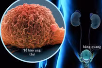 Dấu hiệu ung thư đang tấn công, dễ nhầm với bệnh thông thường