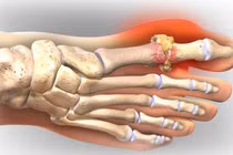 Những đồ ăn làm giảm cơn đau của người bệnh gout