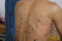 Những trường hợp ong đốt chết người thương tâm