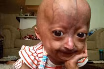 Bé gái 6 tuổi kỳ lạ mang khuôn mặt cụ già