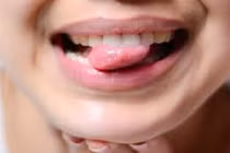 Triệu chứng ung thư lưỡi thường bị bỏ qua vì nhiều người từng mắc