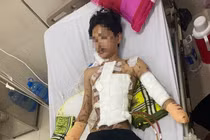 Nam thanh niên mất bàn tay vì tự chế pháo nổ