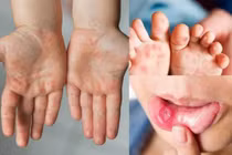300 ca mắc tay chân miệng ở Hà Nội, phòng bệnh thế nào?