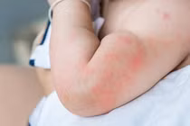 Bé 6 tháng tuổi nhập viện cấp cứu sau ăn lòng đỏ trứng gà